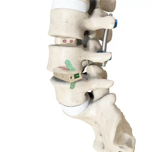 Lumbar Interbody Fusion Cage(Insert-Type)