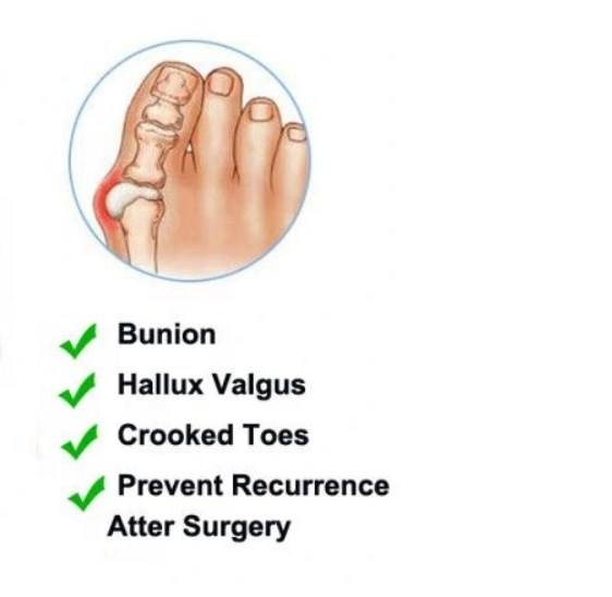 New style  Big Toe Straightener Splint Hallux Valgus Bunion Corrector Orthopedic Bunion Corrector China Supplier