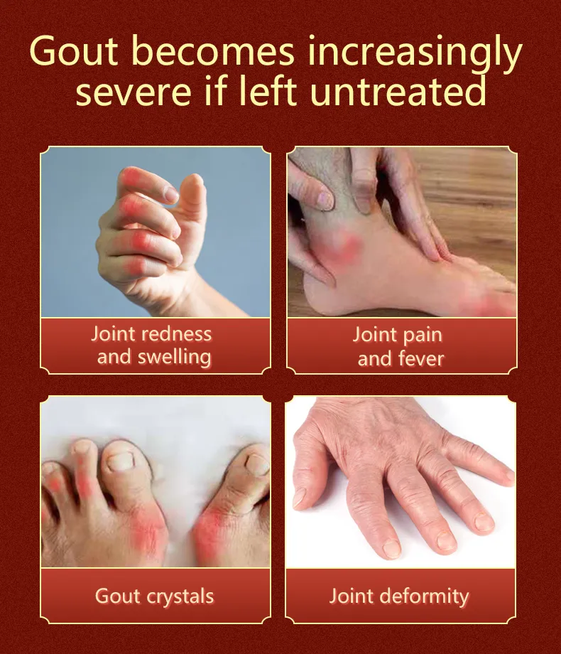 Gout Care Cream Relieve Finger Joint Knee Numbness Swelling Joint Health Cream